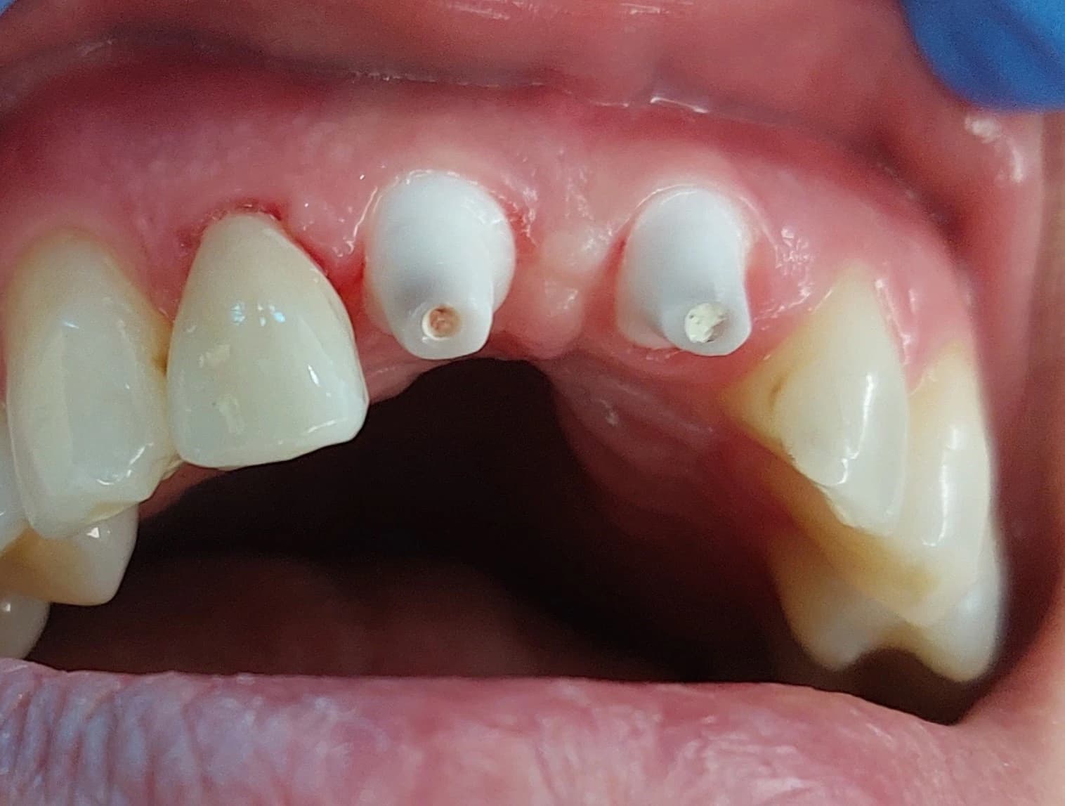 SDS-Keramik-Implantate
